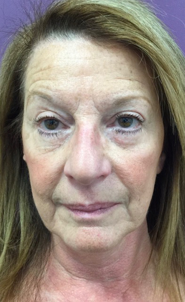 View 1 — before (pre-operative)